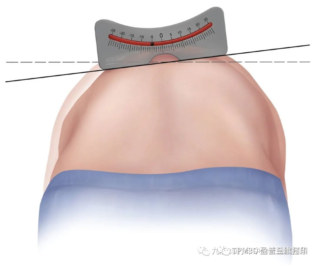 脊柱側(cè)彎?rùn)z測(cè)